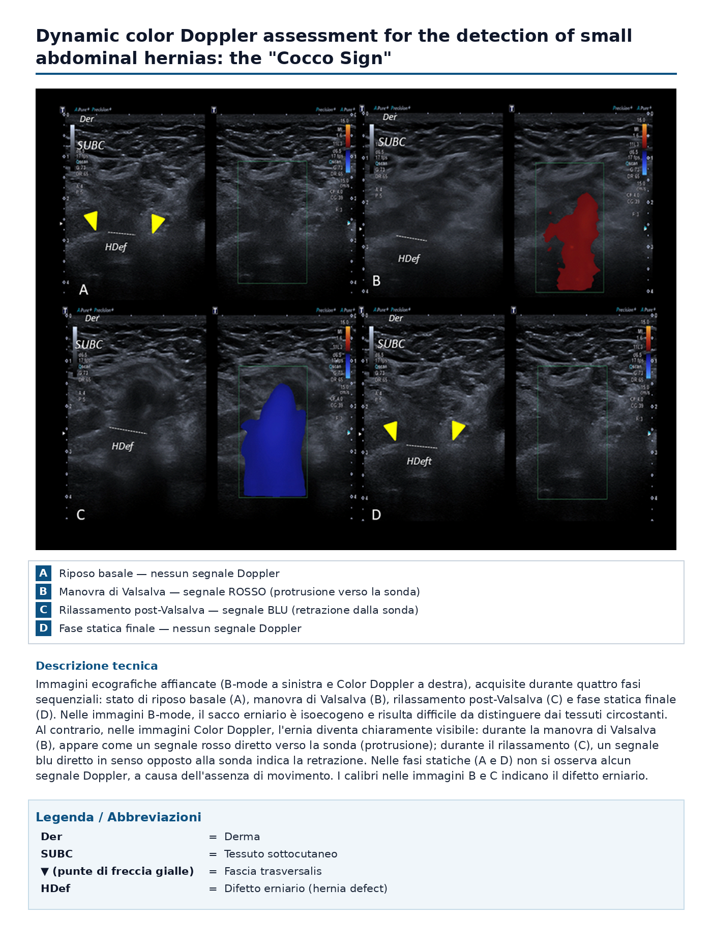 Poster del Cocco Sign con immagini ecografiche B-mode e Color Doppler nelle quattro fasi della valutazione dinamica delle piccole ernie addominali